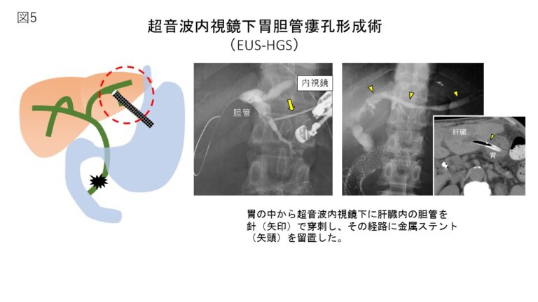 胆膵内視鏡治療 - 魚沼基幹病院